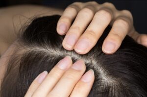 抜け毛が増えたと感じる分け目の頭皮状態