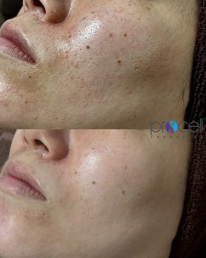 プロセルフェイシャル5回施術前後の肌コンディション比較（水戸市・肌質改善）